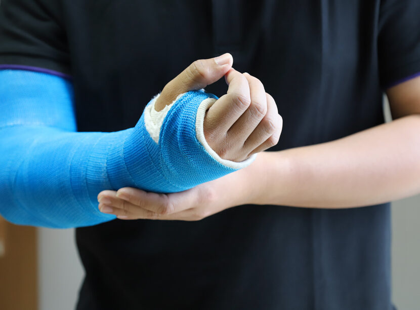 Closeup of a man's arm with long arm plaster
