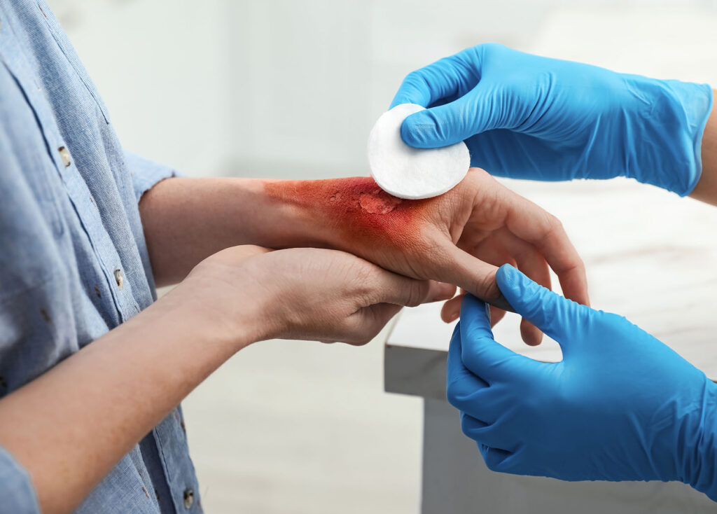 Doctor covering patient's burn of hand with cotton pad indoors