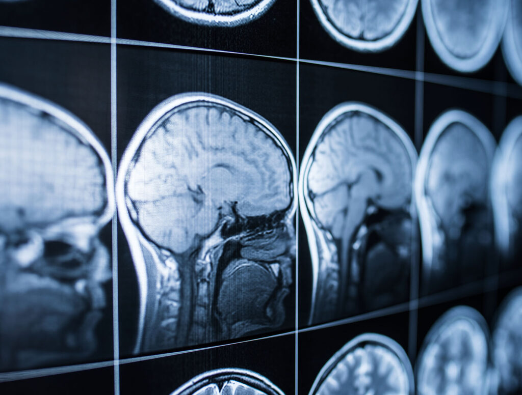X-ray of the head and brain of a person