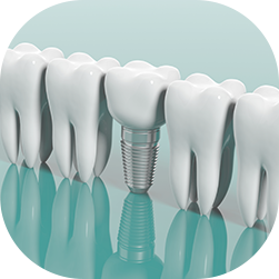 Dental Implants