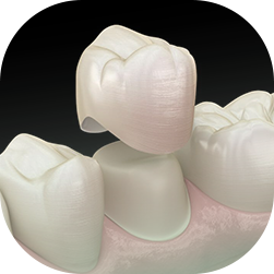 Porcelain Crowns