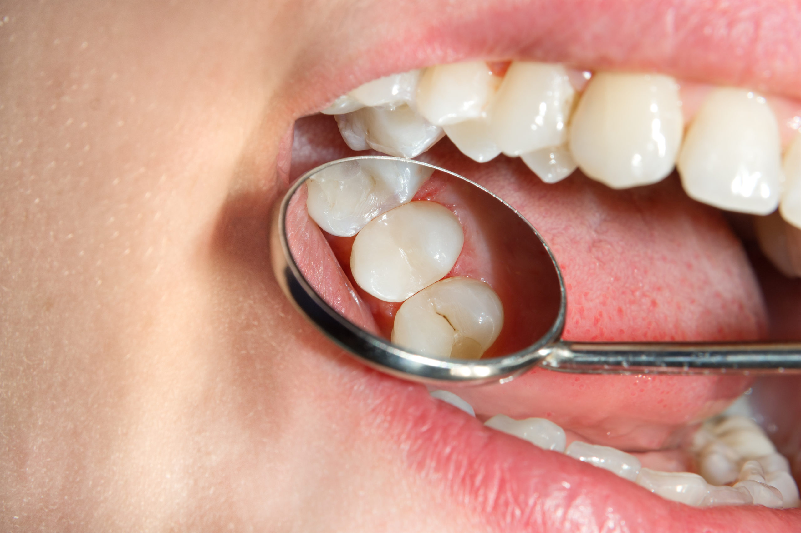 Fillings 2 Dental Filling