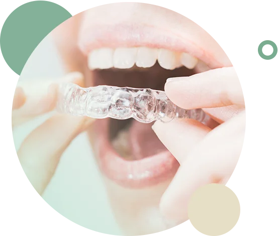 Sure Smile Aligners