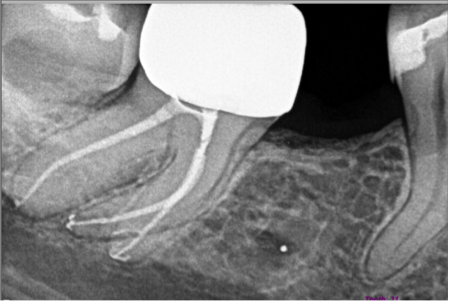 Endodontics in Cumming, GA